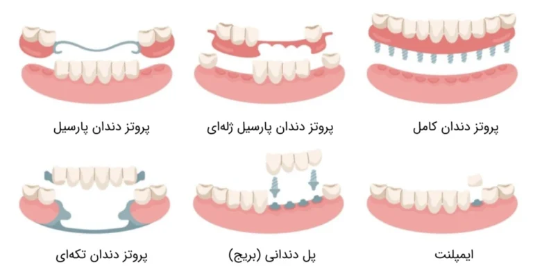 انواع پروتز دندان متحرک