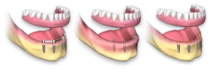 پروتز متحرک کامل