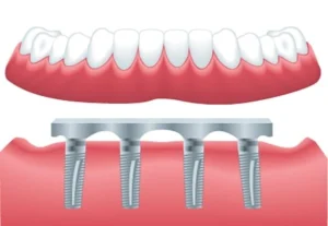 اوردنچر (Overdenture)