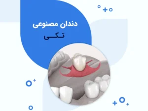 قیمت پروتز دندان تکی چقدر است؟